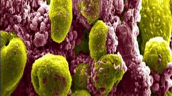 نشانه های سرطان پروستات