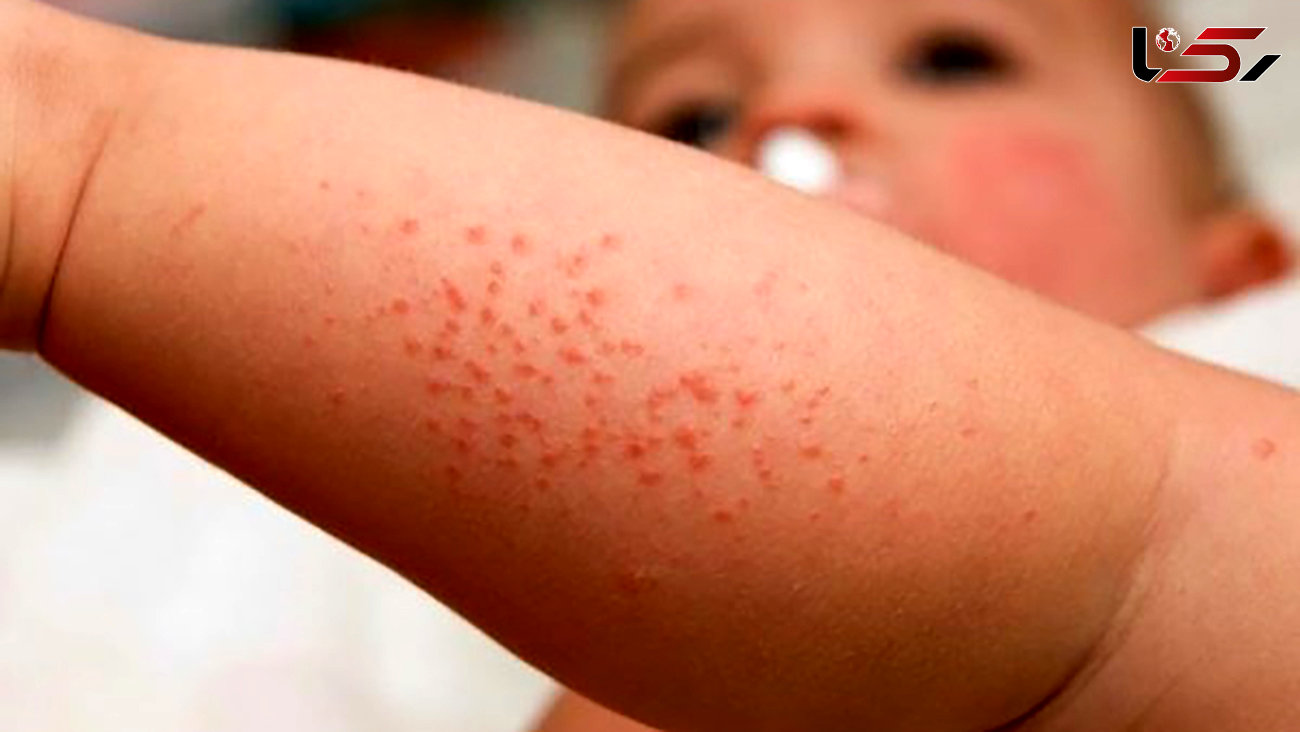 خشکی پوست کودکان را در زمستان جدی بگیرید