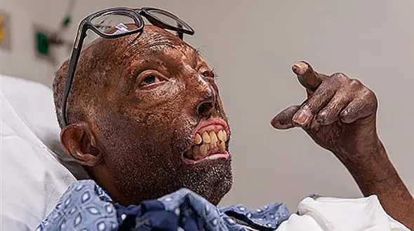 این مرد پس از ۶ سال صاحب صورت شد! + تصاویر