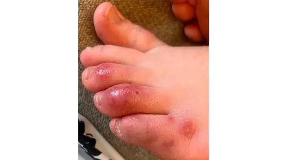 بلایی که کرونا سر پوست تان می آورد + فیلم 