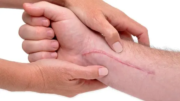 درمان محل زخم و بخیه!