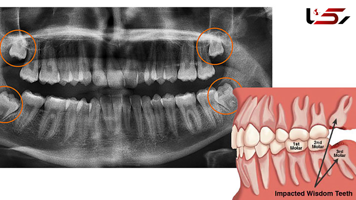 دندان عقل را بکشید 