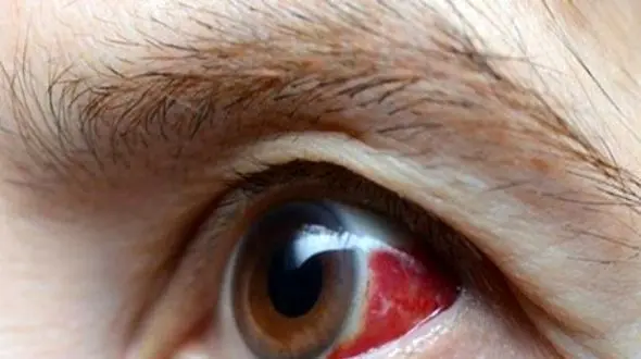 پیشگیری از سکته چشمی: راهکارها و عوامل خطرساز