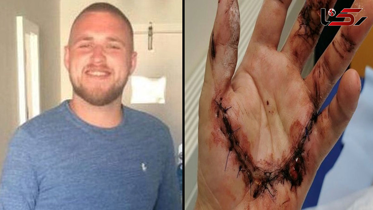 Workman, 25, feared he would lose hand as pole collapsed and severed it at work