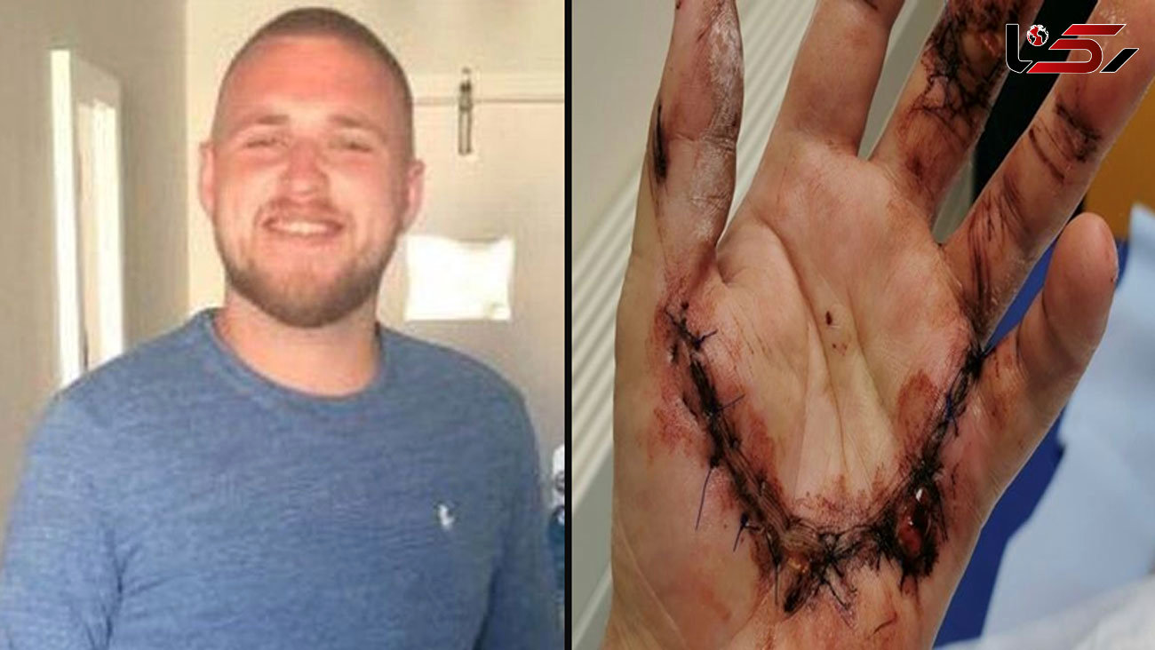 Workman, 25, feared he would lose hand as pole collapsed and severed it at work