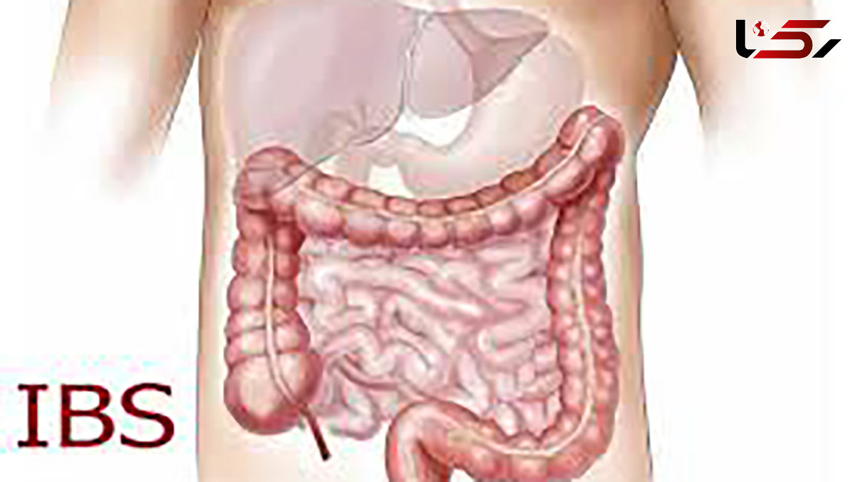 بین 10 تا 20 درصد از جمعیت کشور به IBS مبتلا هستند / زنان بیش از مردان به سندرم روده تحریک پذیر دچار می شوند