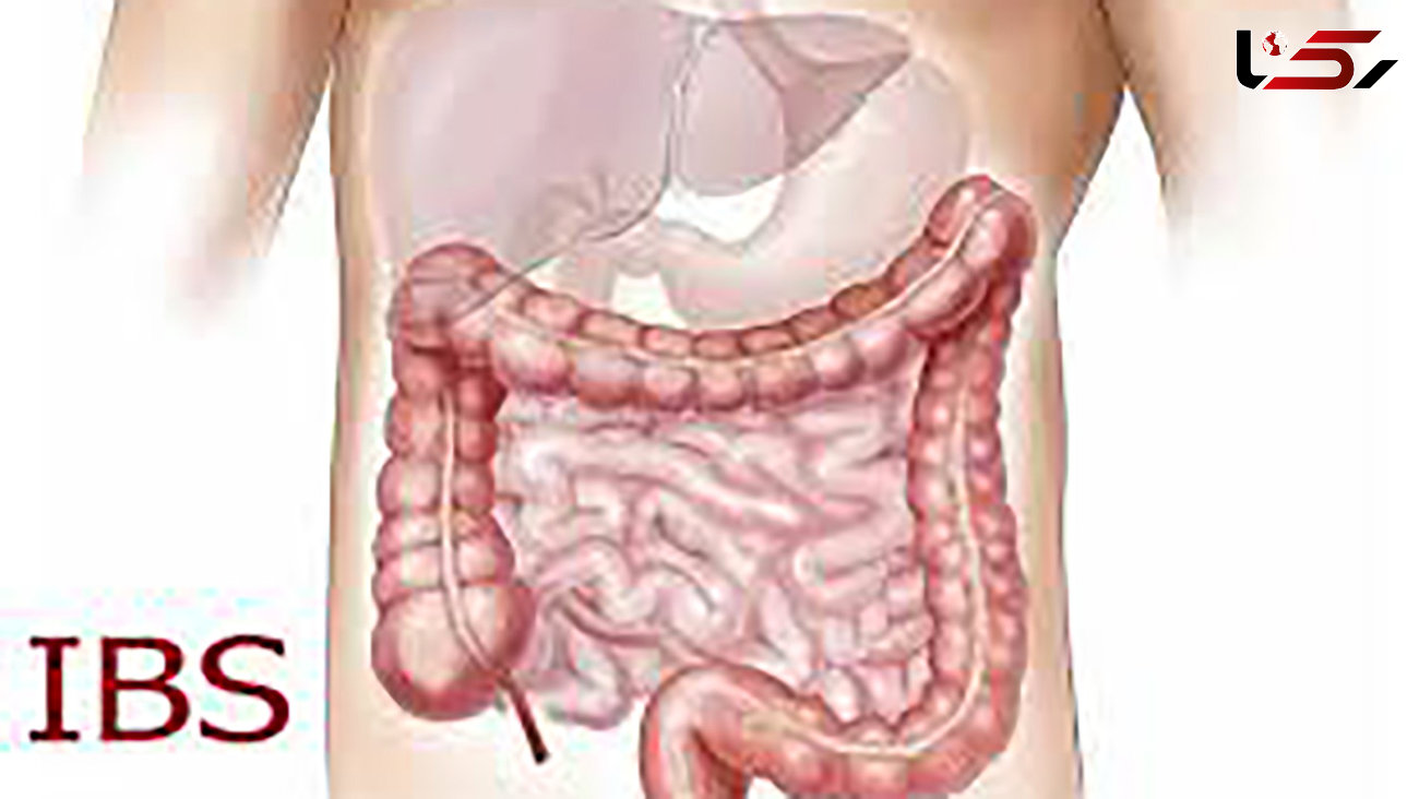 بین 10 تا 20 درصد از جمعیت کشور به IBS مبتلا هستند / زنان بیش از مردان به سندرم روده تحریک پذیر دچار می شوند