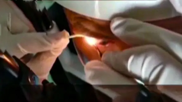 16 + /  زندگی ۲۰ کرم در داخل چشم یک مرد + فیلم 