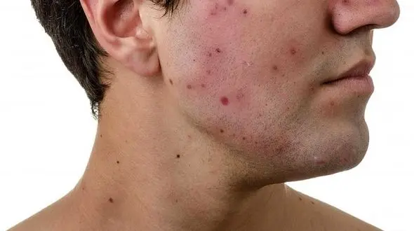 کاهش دما در پاییز و بروز آکنه / راهکارهای درمان