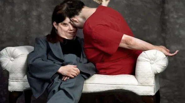 فیلم عجیب ترین دوقلوهای به هم چسبیده جهان ! / هم حمام جداگانه می روند هم اتاق جداگانه دارند !