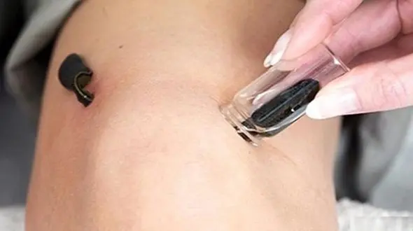 درمان سرگیجه با انداختن زالو