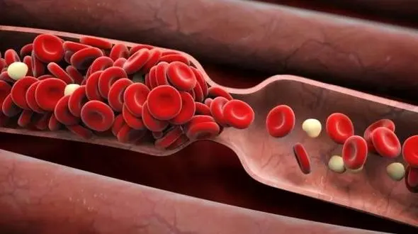 تغییراتی که لخته شدن خون را هشدار می دهند