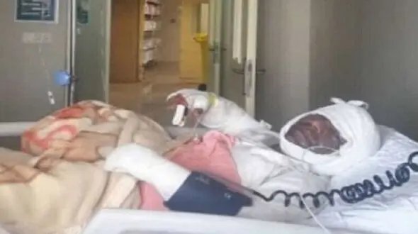 بستری شدن ۳۰ هزار نفر بخاطر سوختگی در ایران/ سالانه 2 هزار نفر دچار برق گرفتگی می شوند