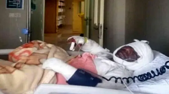 بستری شدن ۳۰ هزار نفر بخاطر سوختگی در ایران/ سالانه 2 هزار نفر دچار برق گرفتگی می شوند