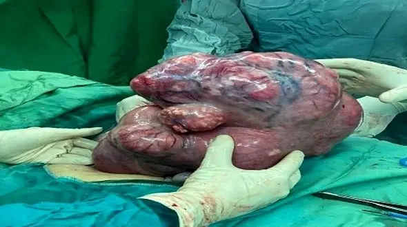 راز شکم برآمده زن 40 ساله فاش شد/ پزشکان قمی شوکه شدند