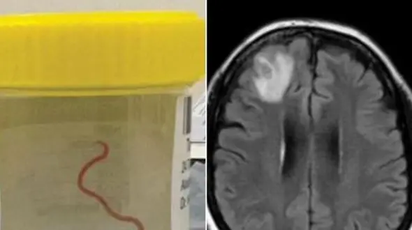 عمل عجیب در تاریخ / پزشکان کرم 18 سانتی را از مغز یک مرد خارج کردند + جزئیات