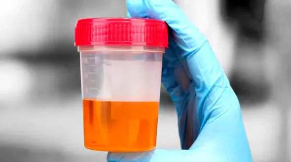 علت بوی بد ادرار چیست؟ تحلیل تخصصی و راه‌حل‌ها