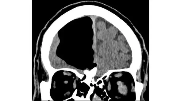 نصف جمجمه این مرد به جای مغز هوا است! / او هیچ مشکلی ندارد + عکس عجیب
