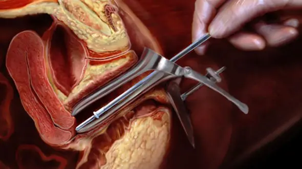 پاپ اسمیر چیست؟ + جزئیات چگونگی تشخص سرطان دهانه رحم