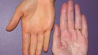 چگونه زردی کف دست را بعد از کار با زردچوبه از بین ببریم؟