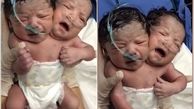 ویدئوی منتشر نشده از لحظه باور نکردنی تولد نوزاد دو سر+عکس