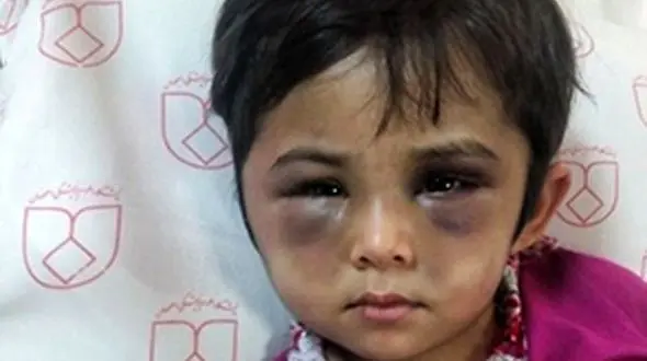 عکس وحشتناک از چهره کبود شده دختر اصفهانی / این ماجرا اشک همه را در می آورد