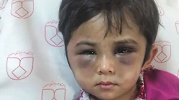عکس وحشتناک از چهره کبود شده دختر اصفهانی / این ماجرا اشک همه را در می آورد