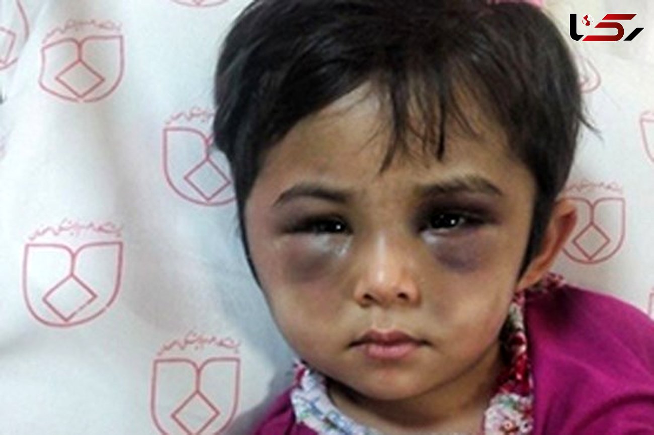 عکس وحشتناک از چهره کبود شده دختر اصفهانی / این ماجرا اشک همه را در می آورد