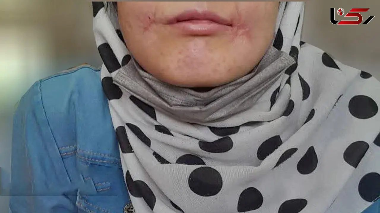 مرد مشهدی لب‌های زن ۱۸ ساله‌اش را دوخت /  فائزه به کلانتری پناه برد + عکس 