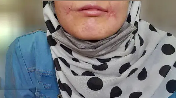 مرد مشهدی لب‌های زن ۱۸ ساله‌اش را دوخت /  فائزه به کلانتری پناه برد + عکس 