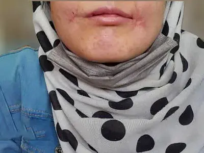 مرد مشهدی لب‌های زن ۱۸ ساله‌اش را دوخت /  فائزه به کلانتری پناه برد + عکس 
