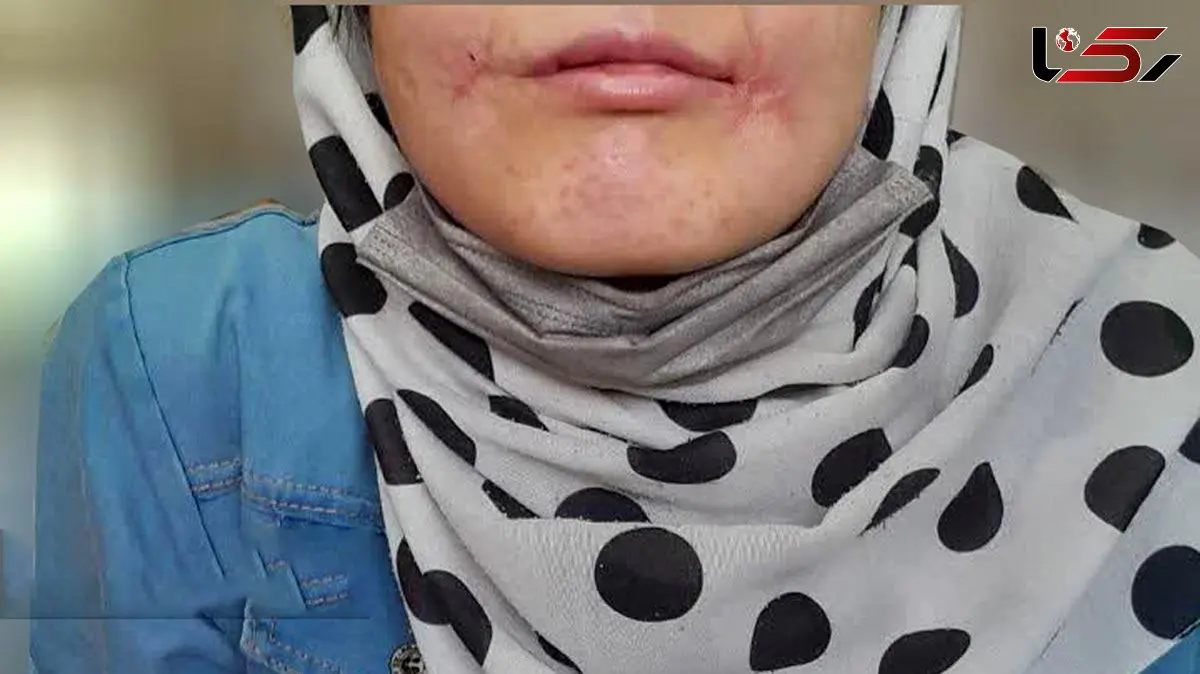 مرد مشهدی لب‌های زن ۱۸ ساله‌اش را دوخت /  فائزه به کلانتری پناه برد + عکس 