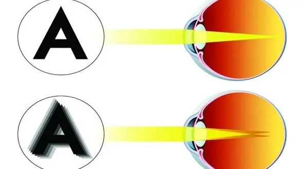 ورزش های مخصوص آستیگمات چشم