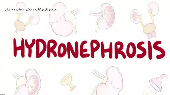 هیدرونفروز چیست؟ / داروهای هیدرونفروز + جدول های مربوط 