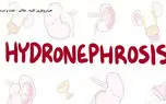 هیدرونفروز چیست؟ / داروهای هیدرونفروز + جدول های مربوط 