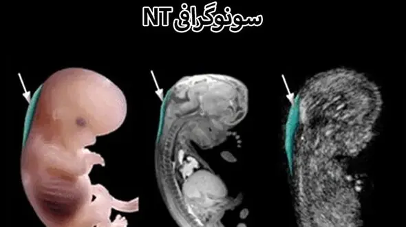 سونوی ان تی چیست؟ / نحوه انجام و سوالات رایج 