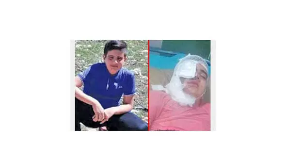 زیبایی صورت پسر 12 ساله توسط مرد کینه جو از بین رفت! / در کرمانشاه رخ داد + عکس قبل و بعد از حادثه