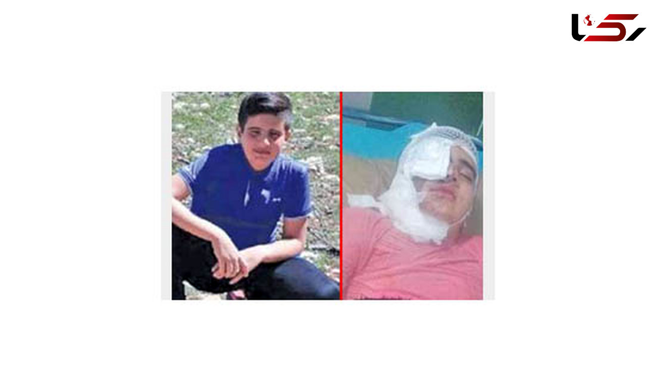 زیبایی صورت پسر 12 ساله توسط مرد کینه جو از بین رفت! / در کرمانشاه رخ داد + عکس قبل و بعد از حادثه