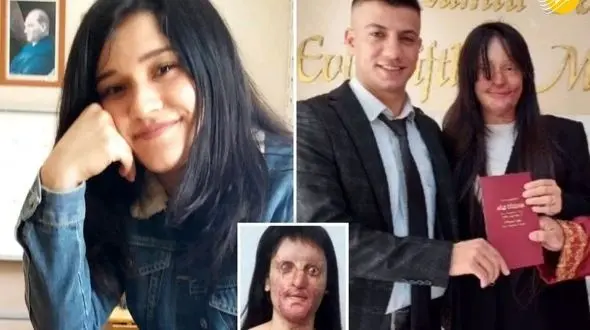 اسیدپاشی به صورت دختر 20 ساله / ازدواج مرداسیدپاش بعد از زندان با این دختر + عکس ها