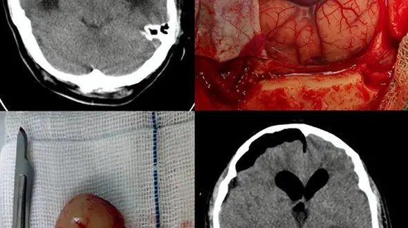 عکسی عجیب از چیزی که داخل جمجمه مرد لامردی بود + جزییات