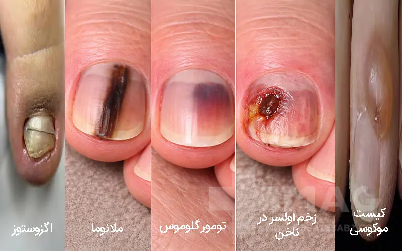 تغییر ناخن ها از بیماری های ناخن