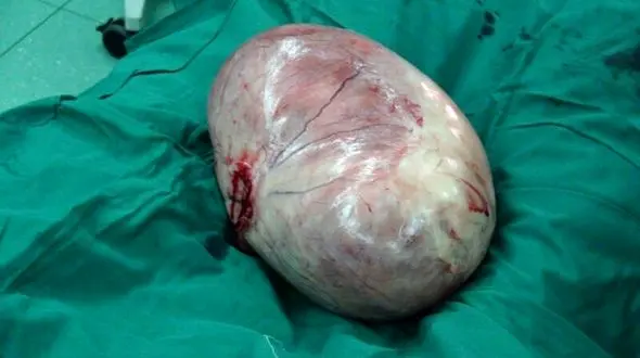 راز شکم برآمده مرد آملی چه بود؟ / پزشکان شوکه شدند