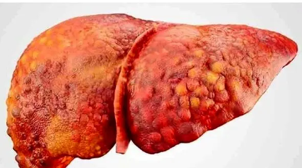 هشدار وزارت بهداشت به برخی باورهای نادرست گیاهی برای درمان کبد چرب