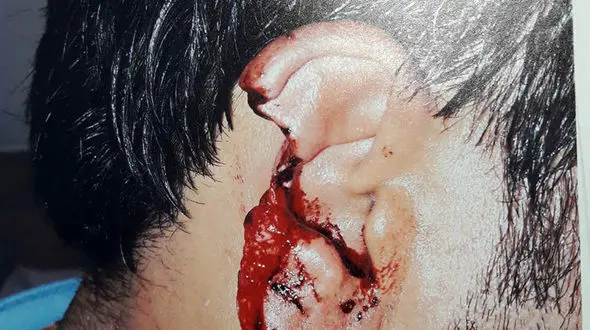 عکس کنده شدن گوش یک مرد با دندان های برادرش! / در تهران رخ داد + جزییات