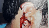 عکس کنده شدن گوش یک مرد با دندان های برادرش! / در تهران رخ داد + جزییات
