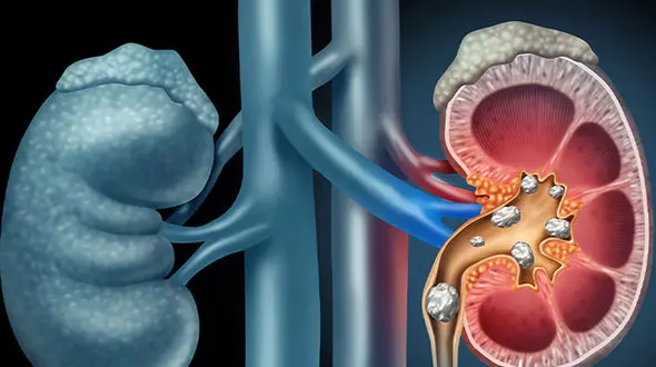 9 راهکار تغذیه ای برای مدیریت سنگ کلیه