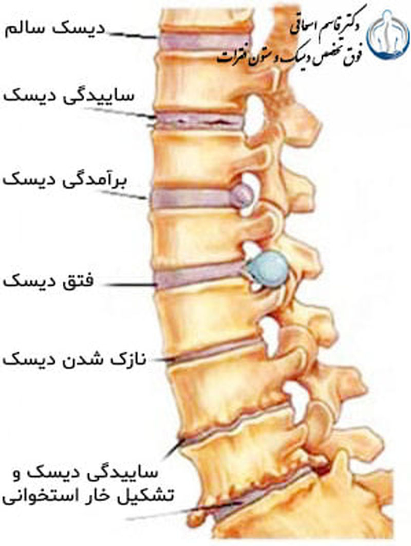 انواع  بیماری دیسک