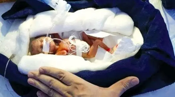 کم وزن‌ترین نوزاد جهان به دنیا آمد + عکس