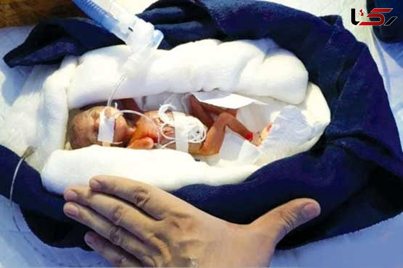 کم وزن‌ترین نوزاد جهان به دنیا آمد + عکس