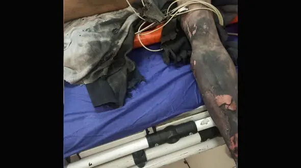 انفجار در منزل مسکونی،پسر 15 ساله دچار سوختگی شدید شد